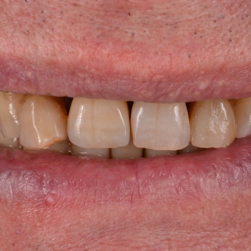 Treatment of the front teeth and fitting of the crown